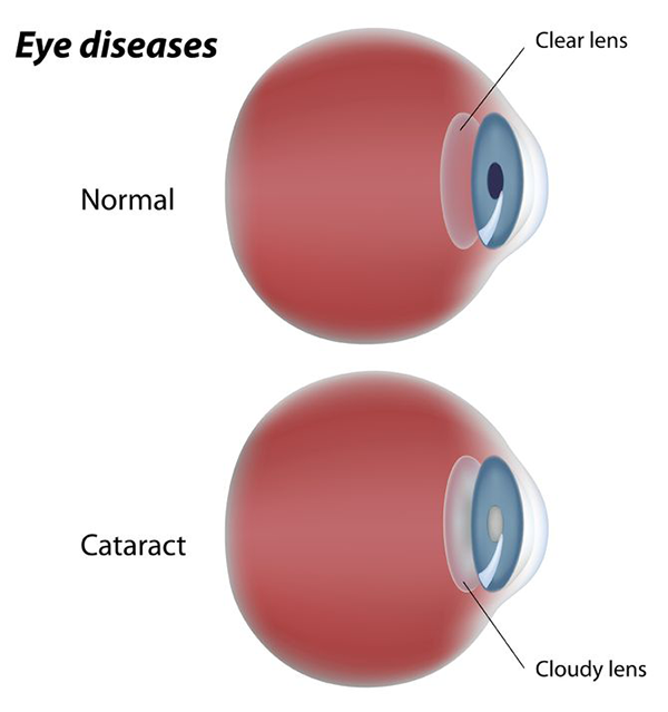 Cataract Surgery Carlsbad