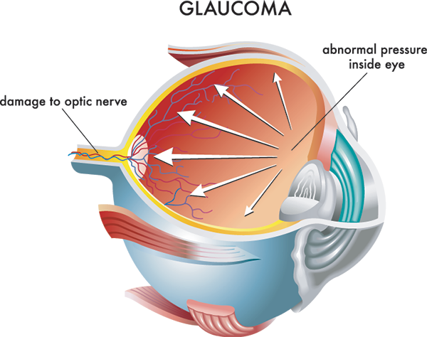 Carlsbad Glaucoma Treatment