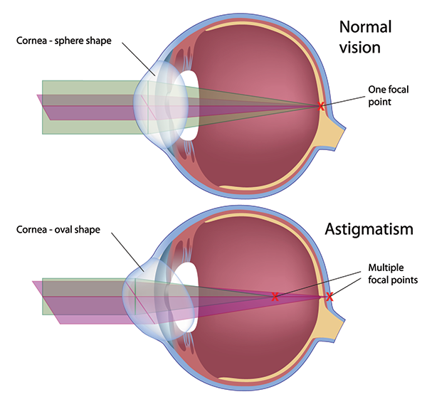 Astigmatism in Carlsbad