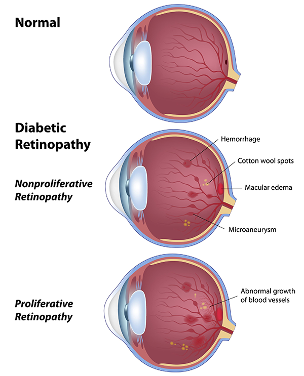 Diabetic Retinopathy Carlsbad