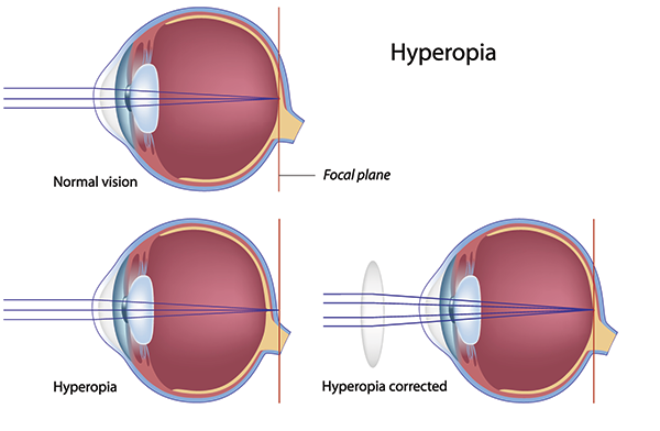 Carlsbad Farsightedness