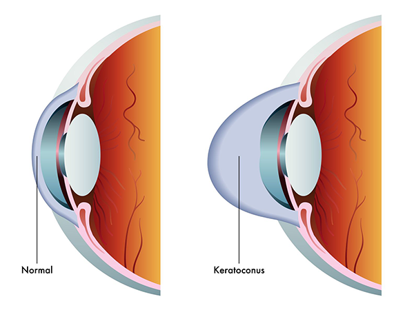 Keratoconus Carlsbad