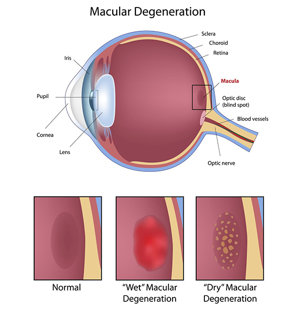 Macular Degeneration Carlsbad