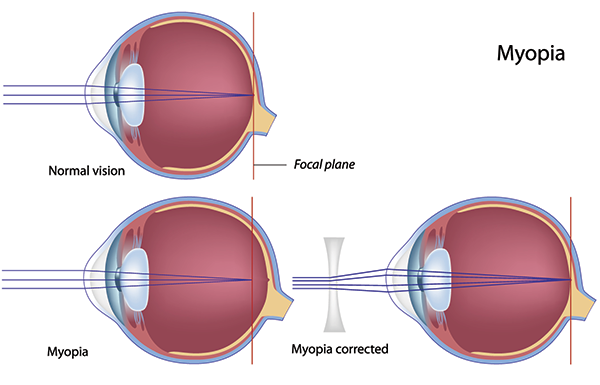 Carlsbad Nearsightedness