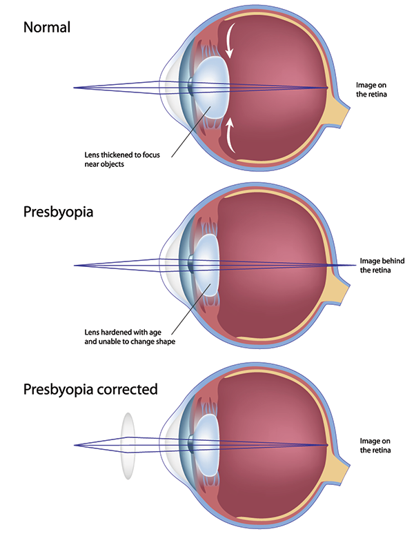 Presbyopia Carlsbad